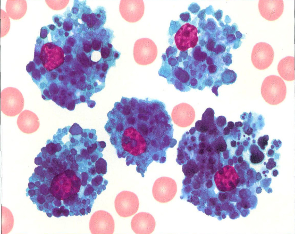 图293 继发性海蓝组织细胞增生症骨髓象(集中视野)